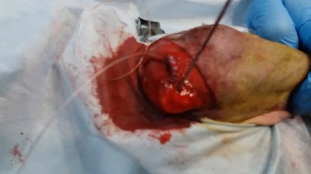 Вывих лопаточно-плечевого сустава смотреть онлайн