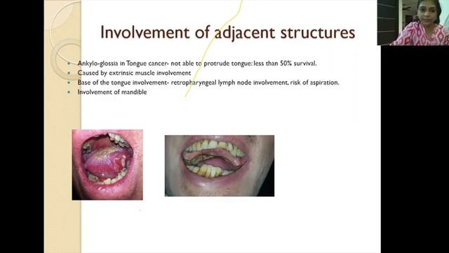 Oral Cancer Webinar смотреть онлайн