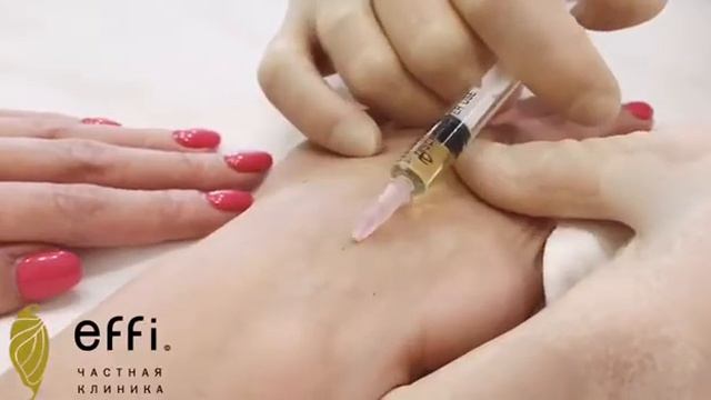 Как сделать так, чтобы руки всегда были молоды и свежи. Одно из решений - мезотерапия рук в effi смотреть онлайн