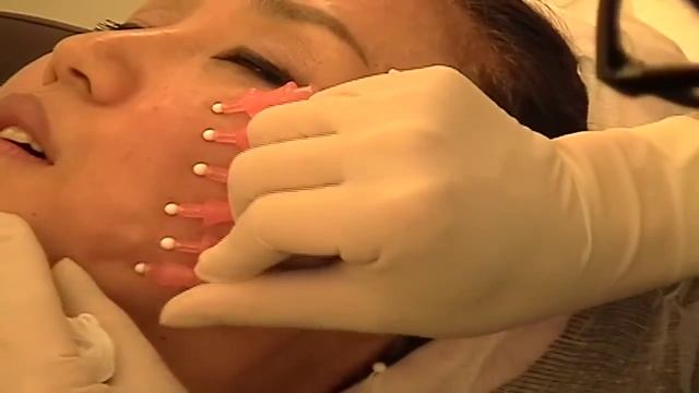 TML TCR PDO Thread Face Lift