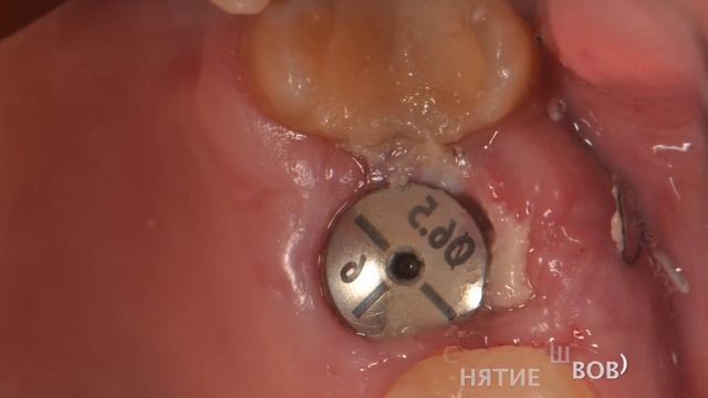 одномоментная имплантация смотреть онлайн