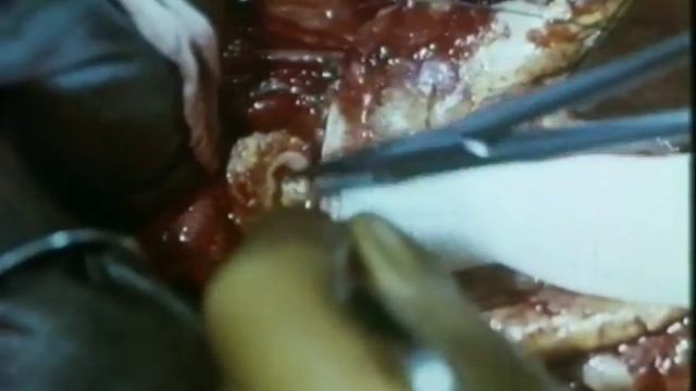 Хирургическое лечение аневризмы брюшной аорты, 1979