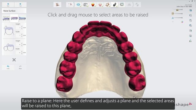 3Shape Splint Studio - The general workflow for Splint Studio смотреть онлайн