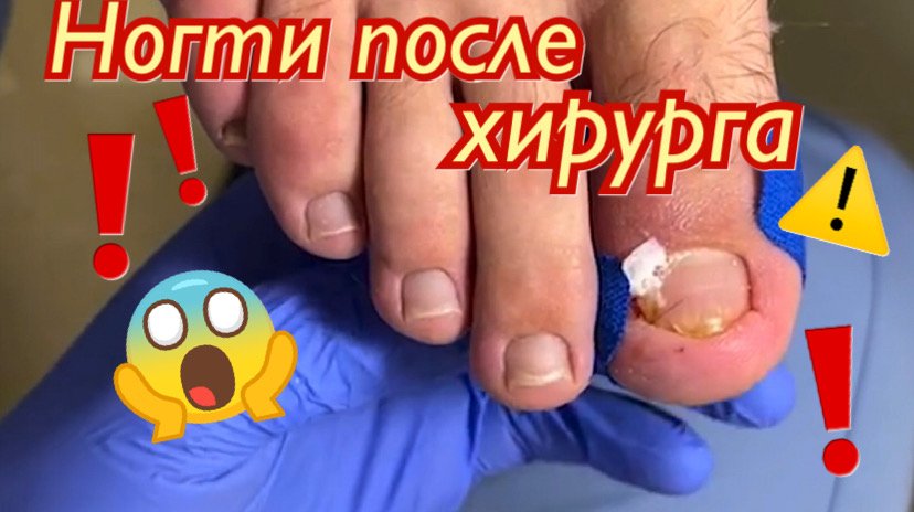 Ногти после хирурга ??❗️⚠️??? смотреть онлайн