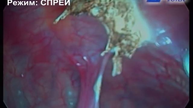 Пережигание плевральных спаек методом АПК смотреть онлайн