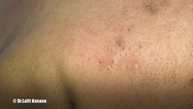 BIG BIG BLACKHEAD REMOVAL