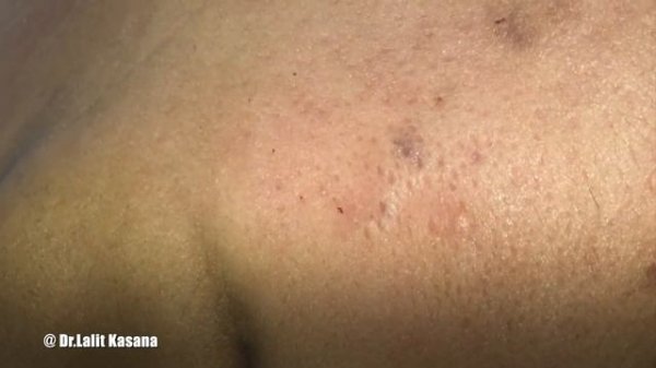 BIG BIG BLACKHEAD REMOVAL