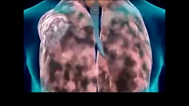 Як із часом змінюється структура легень у курця? смотреть онлайн