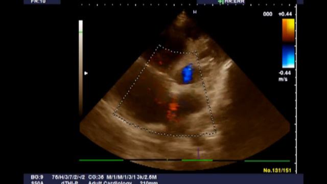 Дефект межпредсердной перегородки.m2v смотреть онлайн
