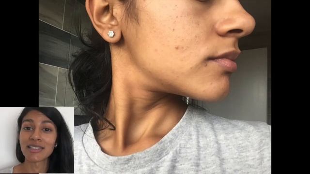 AHA 30 % THE ORDINARY SOLUTION | BEFORE & AFTER | ACNE SUFFERERS | 5 Week Review/ Pictures Tictok смотреть онлайн