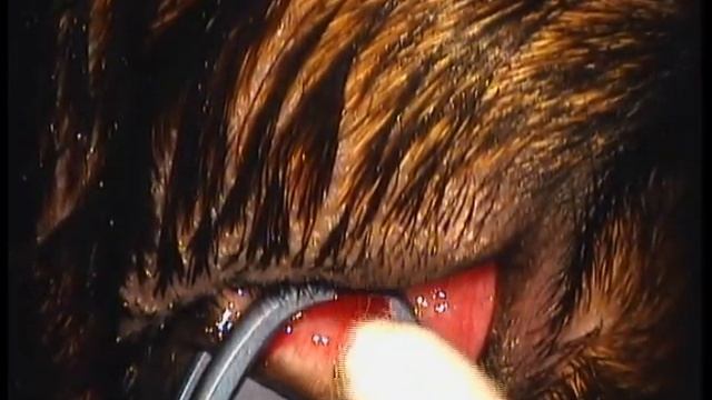 Удаление эктопической ресницы смотреть онлайн