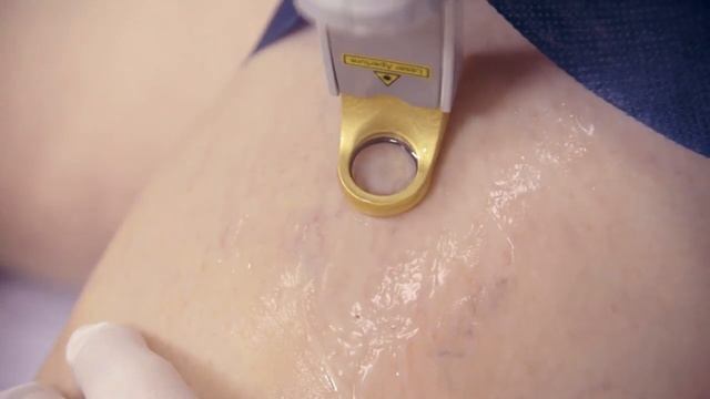 Excel V Leg Veins Therapy Part 2 - Remove Leg Veins Using Cutera XEO Laser Treatment смотреть онлайн