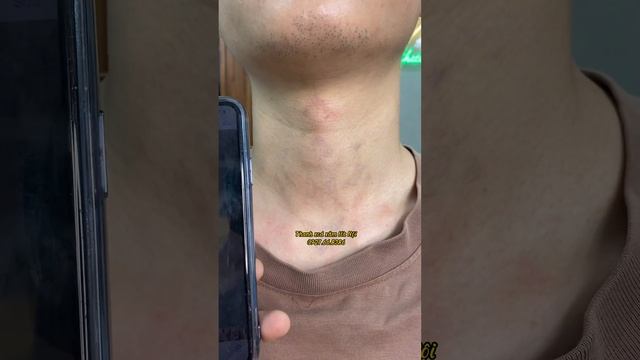 Kêt thúc liệu trình xoá xăm смотреть онлайн