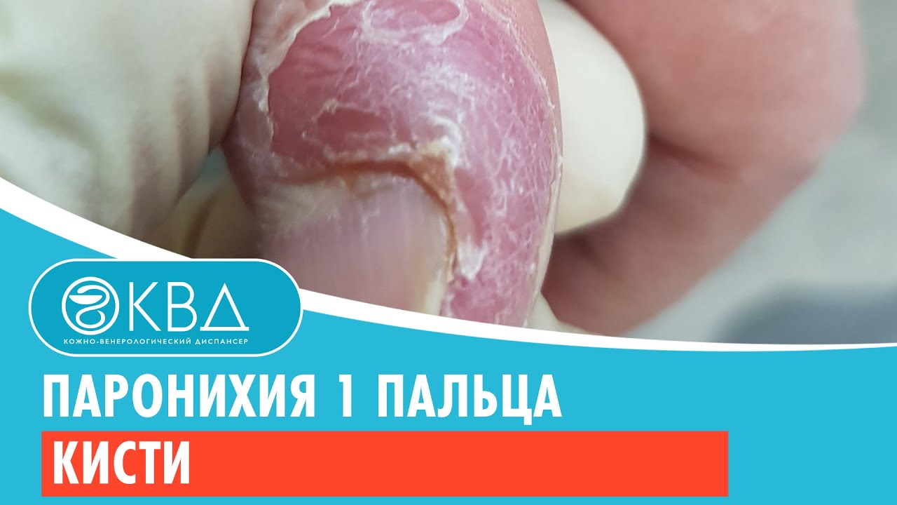 ? Паронихия 1 пальца кисти. Клинический случай №276