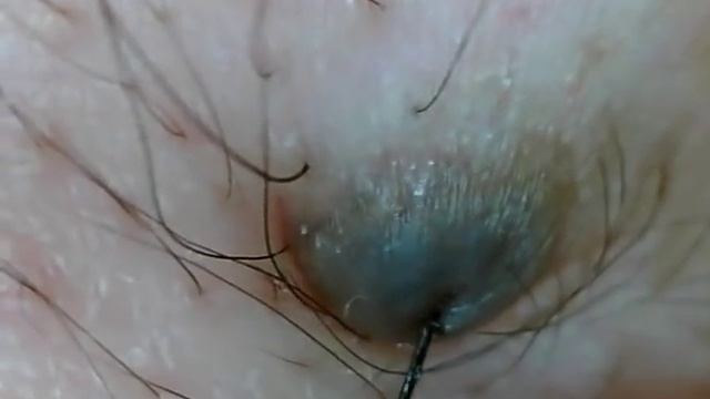 ほくろの毛を引っこ抜く！part7 Hair of a mole! смотреть онлайн
