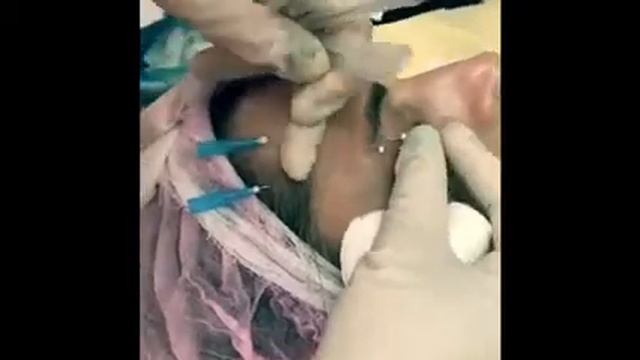 Подтяжка бровей , устранения птоза верхнего века смотреть онлайн