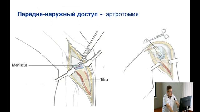 Переломы проксимального отдела большеберцовой кости смотреть онлайн