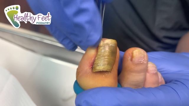 THREE LAYERS OF NAIL FUNGUS смотреть онлайн