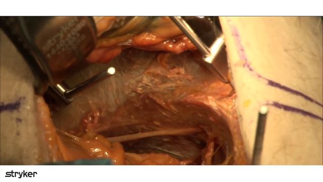 Anterior intra-pelvic approach with Dr.’s Claude Sagi, Michael Archdeacon & Marcus Sciadini смотреть онлайн