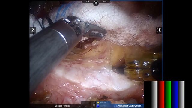 Robotic assisted esophagectomy, McKeown approach, thoracic lymph nodes dissection смотреть онлайн