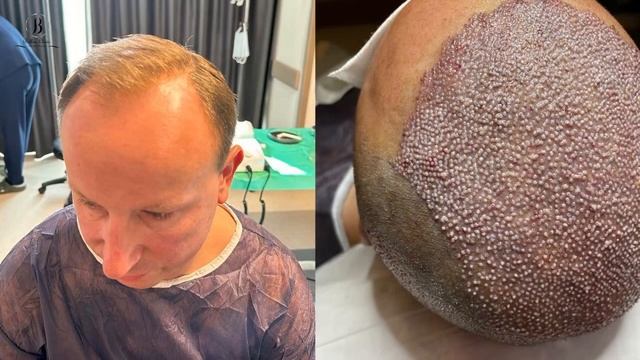 4500 grafts transplanted per one session / hair restoration смотреть онлайн