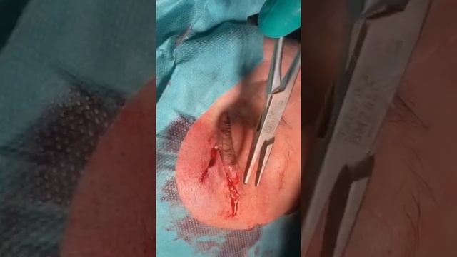 Хирургическое удаление узловой базально-клеточной карциномы кожи нижнего века с пластикой смотреть онлайн