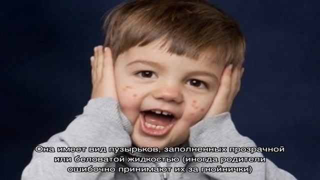 Ангина у ребенка в 1, 2 и 3 года смотреть онлайн