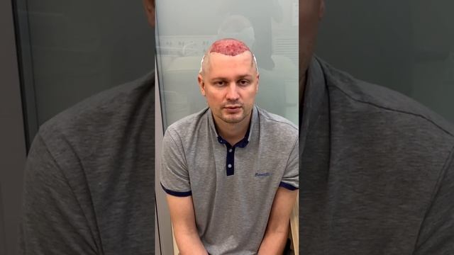 Пересадка волос в Москве #пересадкаволос #пересадкабровей смотреть онлайн