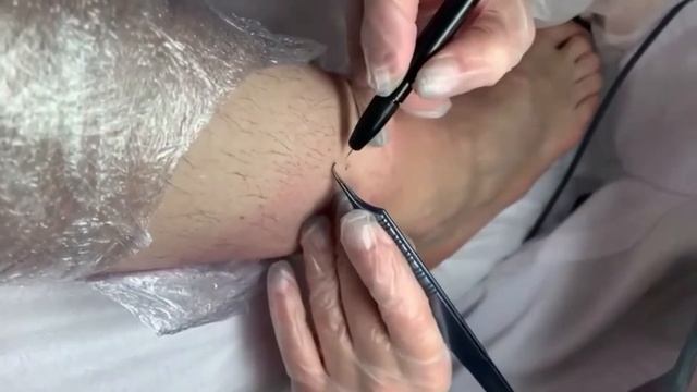 Электроэпиляция голени методом Blend