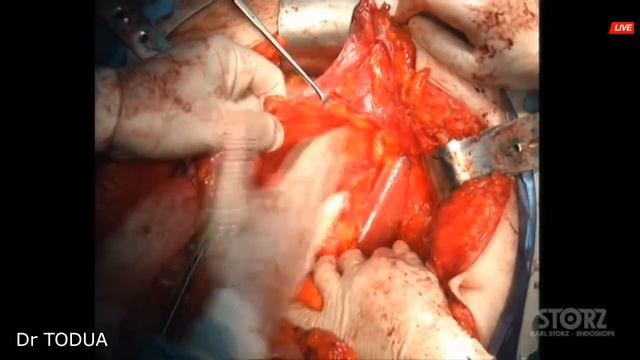 Cytoreductive surgery for Ovarian cancer IIIC. смотреть онлайн