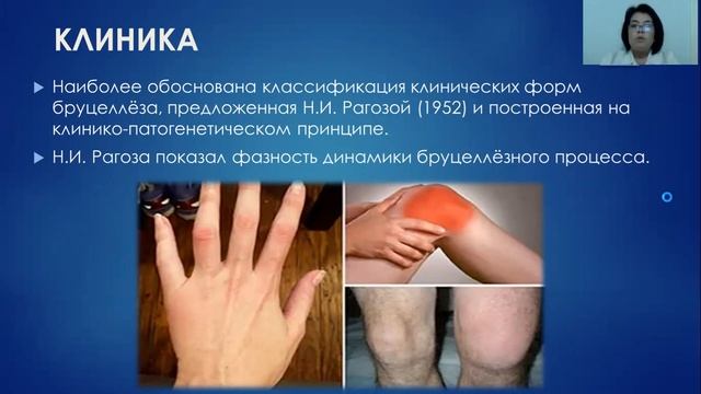 бруцеллёз (рус.)