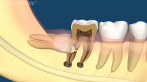 Сложное удаление зубы мудрости
