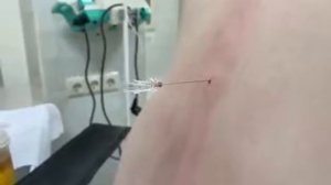 Спинальная анестезия