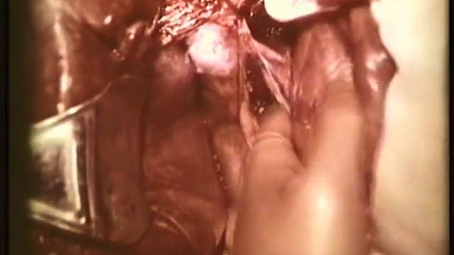 Трансдуоденальная холедохотомия © Transduodenalnym choledochotomy смотреть онлайн