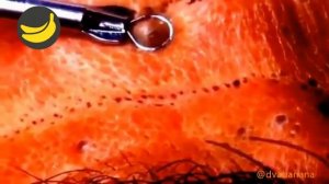 Выдавливание прыщей косметологической петлей