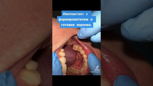 Формирователь десны ,как выглядит?Циркониевая коронка на винте на имплантанте смотреть онлайн