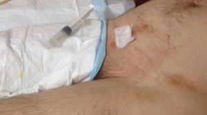 Замена цистостомы в спешке, результат, поврежденная уретра