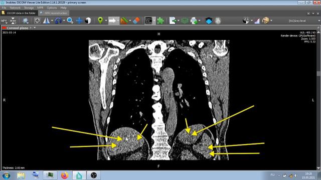 КТ ЛЁГКИХ . смотреть онлайн