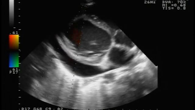 Тампонада сердца (Cardiac tamponade disease). смотреть онлайн
