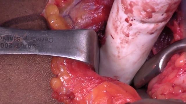 Distal Biceps Tendon Reconstruction With Achilles Allograft