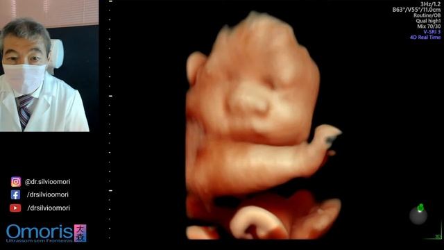 ULTRASSOM 3D 4D. Gravidez 31 Semanas. Imagens Volumétricas.