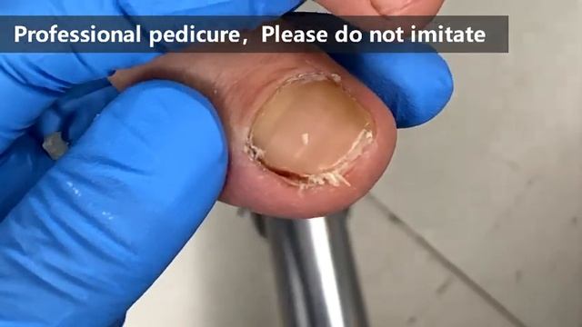 Pedicure Tutorial ：Infrequently Trimmed Nails【Xue Yidao】