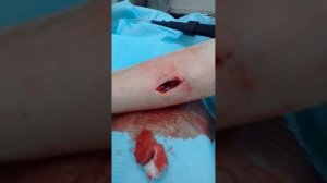 Удаление жировика (липомы) с наложением косметического шва