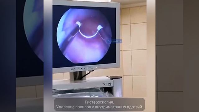 Гистероскопия. Удаление полипов и внутриматочных адгезий. смотреть онлайн