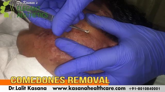 COMEDONE EXTRACTION FULL By POPPING KING DR.LALIT KASANA