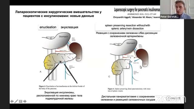 Present diagnostic procedures and treatments in patients with pancreatogenic hypoglycemia смотреть онлайн