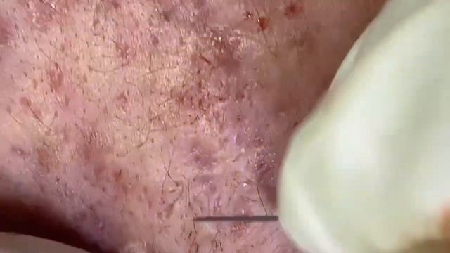 Акне, прыщи выдавливание, чистка лица, ужасы 2022