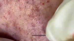 Акне, прыщи выдавливание, чистка лица, ужасы 2022