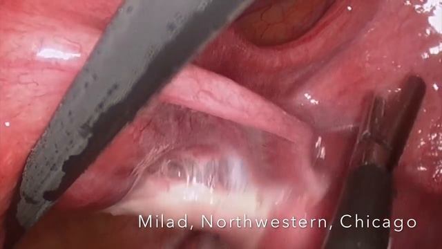 Surgical treatment of blocked fallopian tubes смотреть онлайн