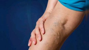 "ОТ ВАРИКОЗА" ДЛЯ ВСЕХ. ВЕДЬМИНА ИЗБА. ИНГА ХОСРОЕВА.